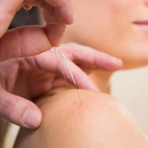 Chiropractic Barrington IL Acupuncture